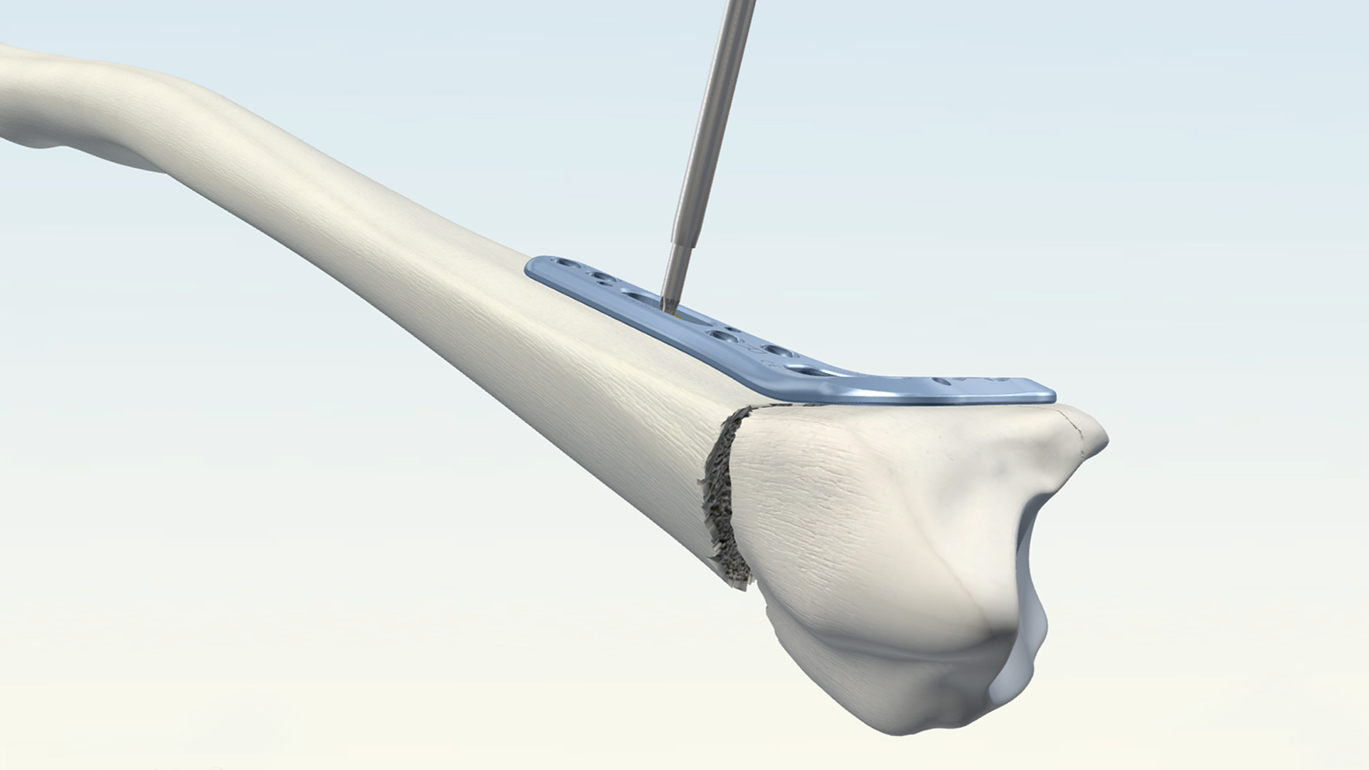 Ortopedic Implant Realtime Application